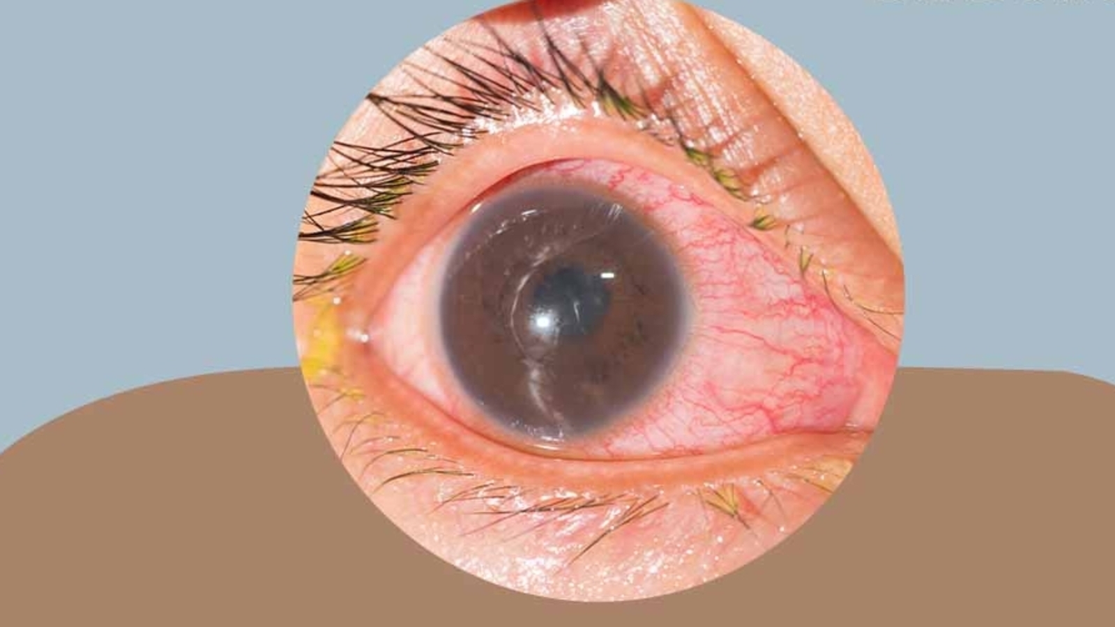 Iritis Or Inflammation Of The Iris Causes Symptoms And Care Tips For Your Eyes Health